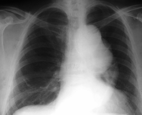Аневризма грудной аорты на рентгенограмме