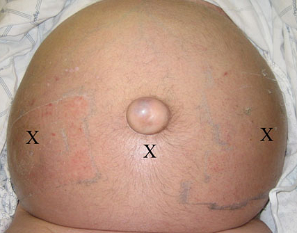 Пример диагноза цирроза печени thumbnail