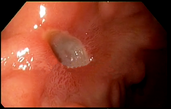 Пример диагноза язвенной болезни 12 перстной кишки thumbnail