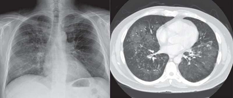 Рентгенограмма грудной клетки при пневмоцистной пневмонии