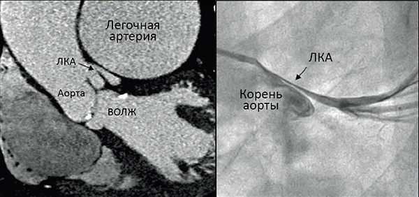 Компрессия левой коронарной артерии при легочной гипертензии