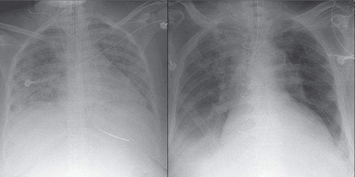 Рентгенография грудной клетки при ОРДС