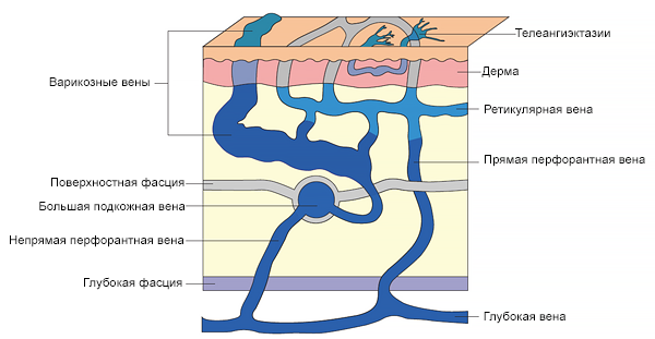 Трансформация венозной гипертензии в аномалии поверхностных вен