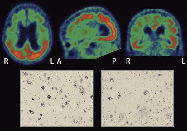 Позитронно-эмиссионная томография при болезни Альцгеймера