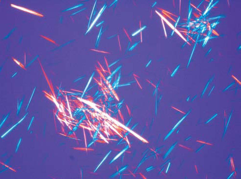 Поляризационная микроскопия кристаллов урата натрия из тофуса