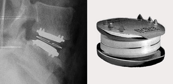 Рентгенография позвоночника с протезом дисков