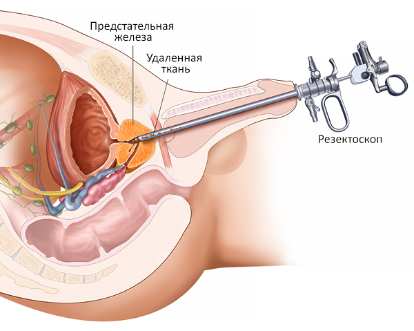 Трансуретральная резекция предстательной железы