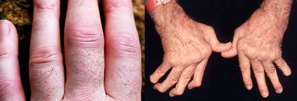 артрит проксимальных межфаланговых суставов, деформация рук у пациента с ревматоидным артритом