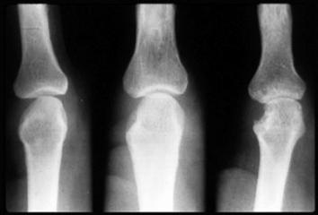 рентгенограмма кистей при ревматоидном артрите