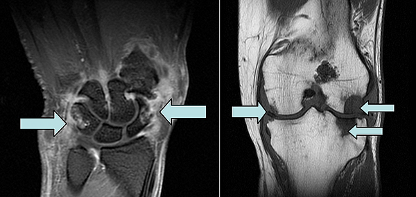 Магнитнорезонансная томография суставов запястья, коленного сустава