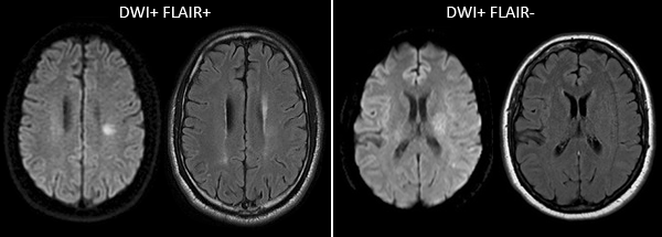 Компьютерная томография мозга при ишемическом инсульте