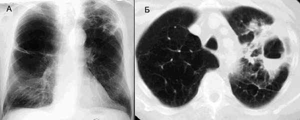рентгенограмма компьютерная томография туберкулеза легких