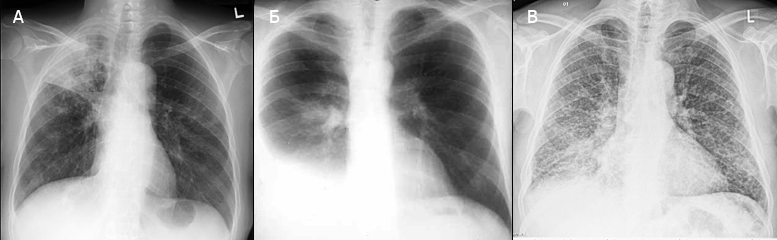 Рентгенограммы у пациентов с туберкулезом легких