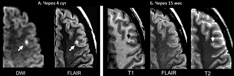 Аномалии диффузно-взвешенных изображений на МРТ при инсульте и ТИА